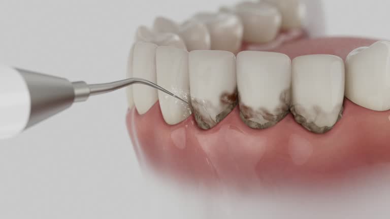 Trusted Wisdom Tooth Removal service in Westlake Village, IL - Dentist Open Now